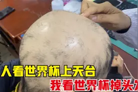 一个月时间、28副中药，头发从无到有，只要治对，生发其实很简单视频封面