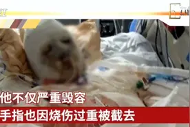 全球首例成功换脸手术：美国男子车祸毁容换掉全脸和双手视频封面