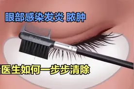 医学演绎 人体眼睛被大量细菌微生物感染发炎脓肿怎么办 如何清理