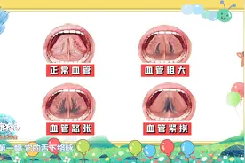 舌底血管发黑发紫是什么情况？中医专家教你通过舌底判断血管健康视频封面
