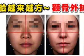 面部变方！变垮！颧骨外扩！视频封面