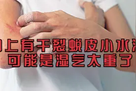 身上手指有干裂蜕皮和小水泡怎么办？可能是湿气太重了视频封面