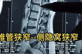 久站行走后小腿憋胀，小腿外侧疼痛，甚至足背麻，腰4/5椎管狭窄视频封面