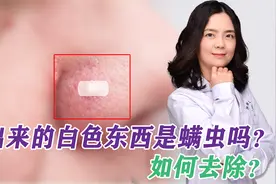鼻子上挤出来的白色丝状物，到底是啥？皮肤医生教你3招祛除