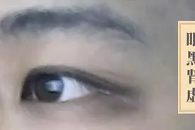 有一种黑眼圈要警惕，它是肾有问题的征兆！赶紧去检查……视频封面