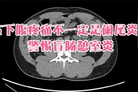 年轻人右下腹疼痛，一定是阑尾炎吗？用CT告诉你可能不是！视频封面