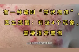 有一种痛叫“带状疱疹”，医生提醒：有这4个现象，需要提高警惕视频封面