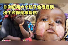 非洲母亲六个孩子全得怪病，出生时像被烧伤，接连失去生命视频封面