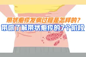了解带状疱疹的七个阶段，有助于减少疼痛，尤其是后期后遗神经痛视频封面