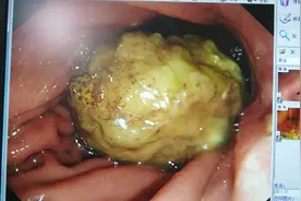 大娘空腹吃了20多颗山楂 结果悲剧了视频封面