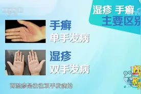 手经常脱皮，是湿疹还是手癣？来听听专家的讲解|生活圈视频封面