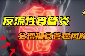 长期胃酸反流、食管炎，严重有啥后果？医生说：腐蚀粘膜致食管癌视频封面