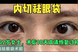 42岁女士内切祛眼袋手术，术前、术后即刻、术后10天恢复过程高清视频封面