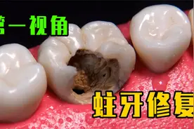 令人惊叹的蛀牙修复手术，被掏空的牙齿最后竟然能完美修复！视频封面