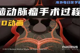 【3D动画】什么是脑动脉瘤，自然破裂后会会有怎样的症状视频封面