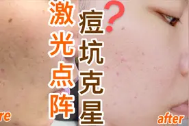 去痘坑 真的有用吗？点阵恢复情况视频封面