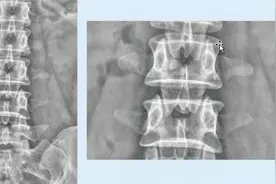 腰椎X线解剖系列：腰椎X线正侧位解剖（二）视频封面