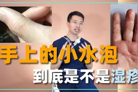手上的小水泡，原来是湿疹！3味中药解决，快速止痒，改善脱皮！视频封面