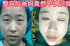 小眼睛单眼皮的我，做眼综合第10天，爸妈竟然不认识我了！视频封面