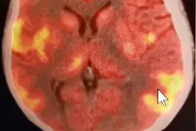深圳一女子发烧昏迷两月不醒，颅脑影像显示脑子正“着火”视频封面