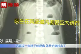 女童胃肠遭“石头”淤堵，竟是柿子惹得祸视频封面