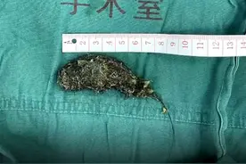 5岁女童腹痛难忍，一查胃镜医生瞬间惊了：胃里全是头发视频封面