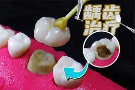 体会保护牙齿的重要性：看着就痛了，模型演示根管治疗龋齿全过程视频封面