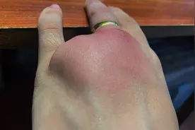被蚊子叮后打沙袋止痒手背肿成桃子 男子：一周才消肿 挺离谱的视频封面