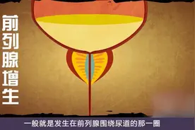 前列腺增生不仅会影响到男性排尿，还会影响性功能导致多种合并症视频封面