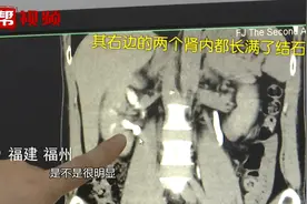 男子长出三个肾，医生：不会多一部iPhone，反而对身体有害视频封面
