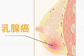乳房胀痛、有肿块会是乳腺癌前兆吗？#滚蛋吧肿瘤君# #清风计划#视频封面
