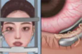 美女长期熬夜不卸妆，第一视角沉浸式清理“脂肪粒”，过程太解压视频封面