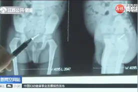 一岁男童误吞2厘米螺丝钉，与器官“和平相处”，3天后顺利排出视频封面