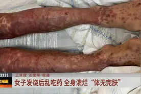 武汉一女子发烧后乱吃药致全身溃烂视频封面