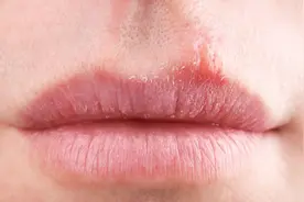 嘴唇上长了疱疹怎么办，别总觉得是“上火”，疱疹发作千万别弄破视频封面
