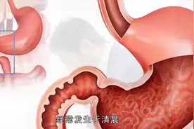患上胃溃疡会有哪些症状表现，这四点最典型！视频封面