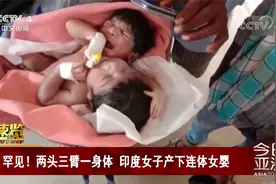 罕见！两头三臂一身体 印度女子产下连体女婴视频封面