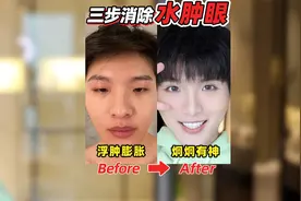 7年上镜血泪经验！水肿眼3步超快速消肿！视频封面