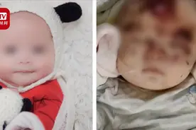 两月女婴疑被老鼠咬成重伤仍在抢救 父亲：赶回近10天 未看到孩子视频封面