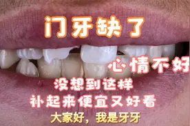 门牙缺了整个心情都不好了，花450补的门牙大家看看值不值视频封面