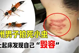广州男子拍打隐翼虫，第2天发现身上长泡，为什么会这样？视频封面