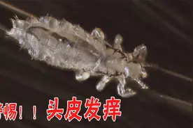警惕貌似头皮屑的头虱！ 头皮发痒就是因为它！头虱的秘密！视频封面