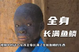 女孩全身长满了鱼鳞，皮肤像干涸的土地裂纹，有点瘆人胆小者勿进视频封面