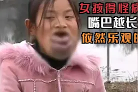 女孩得怪病，随着年龄增长，嘴巴越长越大，邻居：孩子乖巧懂事视频封面