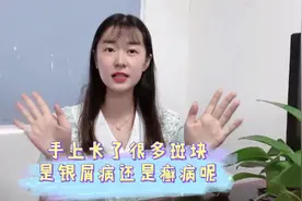 手上长了很多斑，是癣病还是银屑病？教你辨清楚视频封面