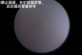 输尿管镜检查输尿管全过程，无删减视频封面