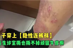 男子穿上【隐性连裤袜】，医生诊室撕也撕不掉顽固牛皮癣视频封面