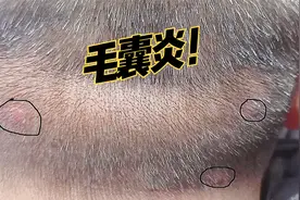后脑勺长了几个疙瘩，一直不好，要小心毛囊炎。视频封面