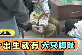 出生就有6只脚趾！父母着急想做手术，医生却不建议，为何？视频封面