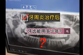 牙周炎的松动牙，治疗后能用多少年？医生为何不爱回答这类问题？视频封面